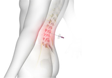 Lumbar Epidurals