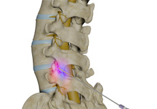 Lumbar Facet Block