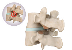 Lumbar Facetectomy and Foraminotomy