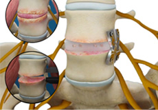 Lumbar Interbody Fusion