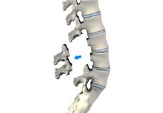 Lumbar Laminectomy