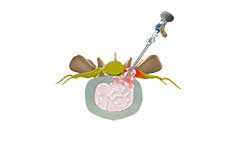 Lumbar Microdiscectomy