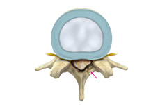 Lumbar Stenosis