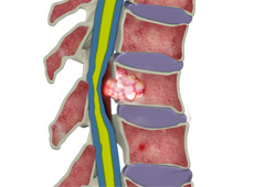 Benign Spinal Tumors