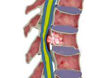 Metastatic Tumors