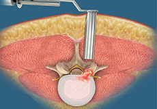 Thoracic Discectomy