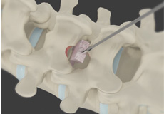 Minimally Invasive Lumbar Discectomy