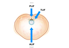 Minimally Invasive Lumbar Fusion