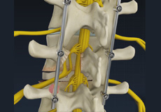 Minimally Invasive TLIF