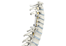 Multilevel Posterior Cervical Laminectomy and Fusion