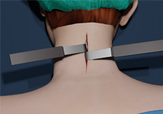 Neck Surgery