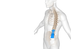 Oblique Lumbar Interbody Fusion