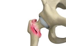 Osteoporotic Fractures