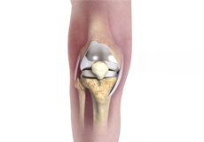 Patient Specific Knee Replacement