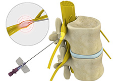 Percutaneous Vertebroplasty