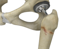 Periprosthetic Hip Fractures