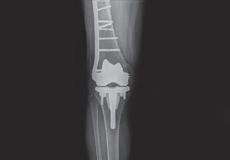 Periprosthetic Knee Fractures