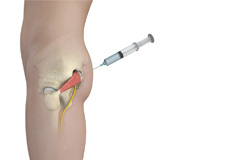 Piriformis Muscle Injection