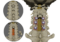 Posterior Cervical Decompression