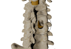 Posterior Cervical Foraminotomy