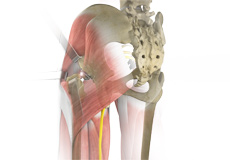 Posterior Hip Replacement