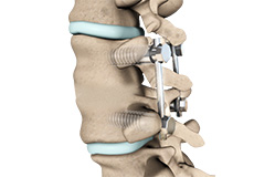 Posterior Lumbar Fusion