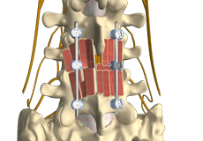 Posterolateral Lumbar Fusion