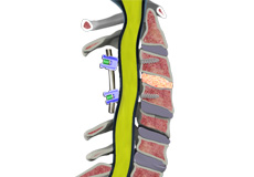 Pseudarthrosis/Nonunion