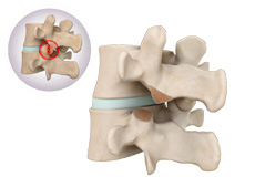 Removal of Facet Joint Cyst