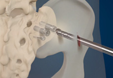 Sacroiliac Joint Minimally Invasive Fusion