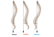 Sagittal Imbalance