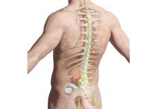 Spinal Cord Stimulator