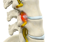 Spinal Decompression Therapy