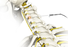 Spinal Facet Rhizotomy