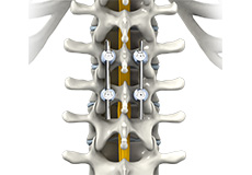 Cervical Spine Fusion