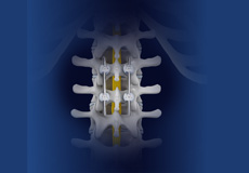 Spinal Fusion