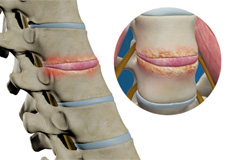 Spinal Infection Debridement