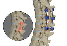 Spinal Infection