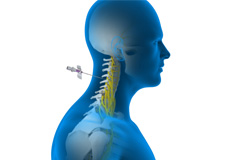 Spinal Nerve Blocks