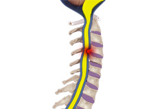 Spine Disorders