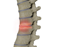 Spondylodiscitis