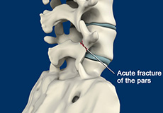 Spondylolysis