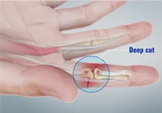 Tendon Injuries