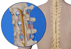 Thoracic Corpectomy