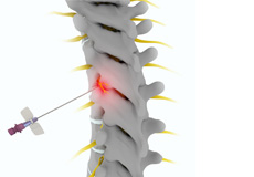 Thoracic Facet Joint Injection