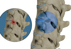 Thoracic Facetectomy