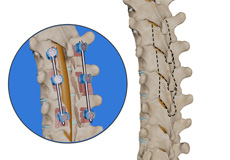 Thoracic Laminectomy