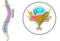 Thoracic Myelopathy