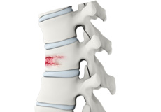 Thoracic Spine Fracture Repair Surgery
