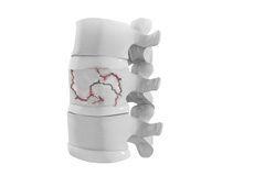 Thoracic Spine Trauma Surgery